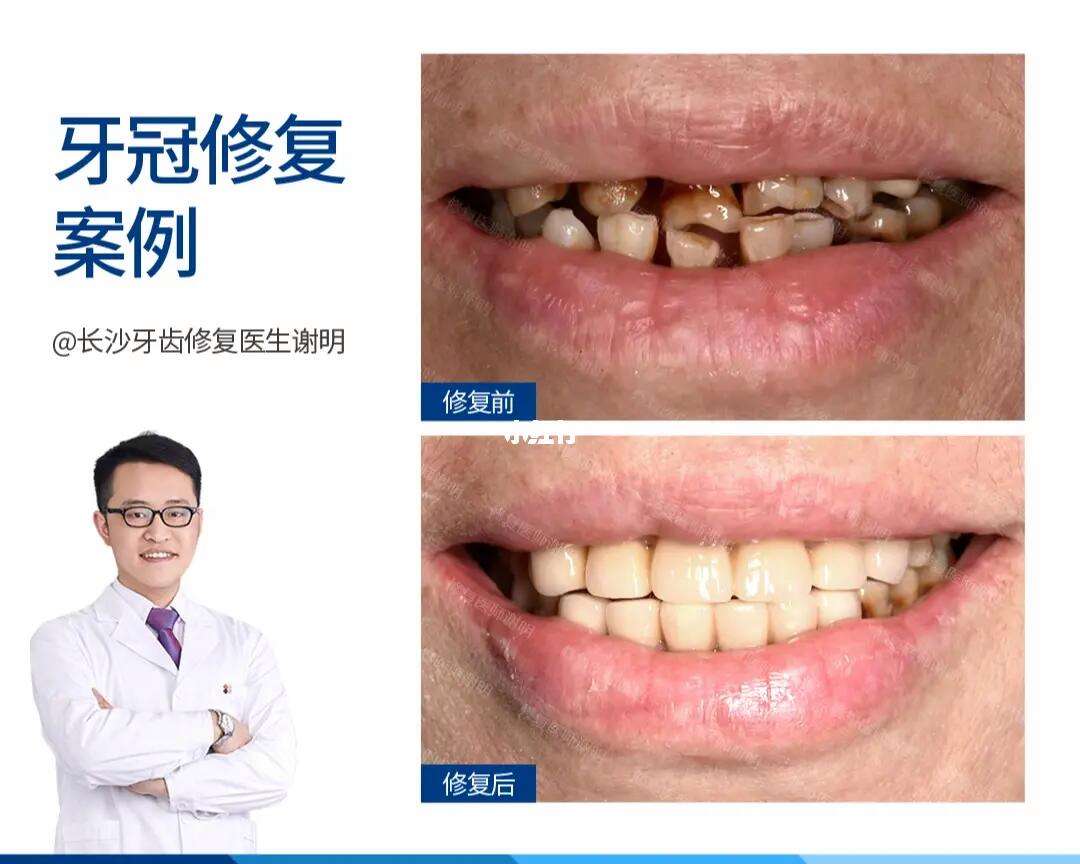 梦见拔牙是什么意思周公解梦
